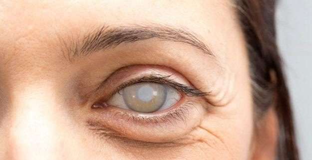 Cataract Surgery Sydney