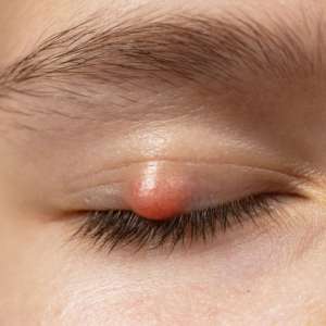 Eyelid Lump Chalazion