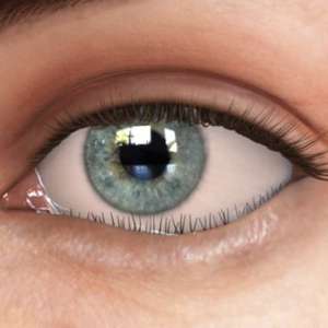 Ingrown Eyelashes Entropion Ectropion