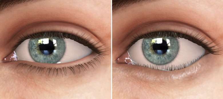 ingrown eyelash treatment Sydney
