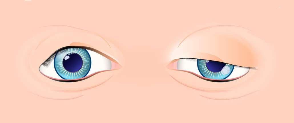 Ptosis Surgery Sydney