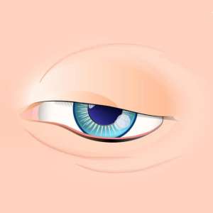 Ptosis droopy eyelid