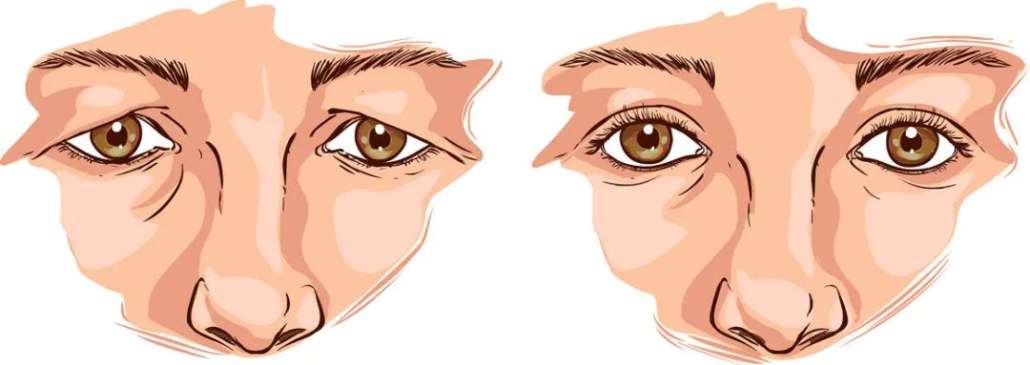 Blepharoplasty Sydney